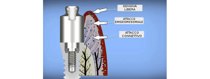 equator biologic abutment attacchi per impianti