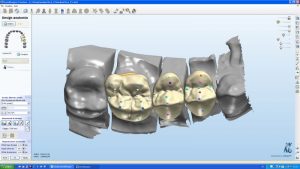 CAD-CAM dentale 2