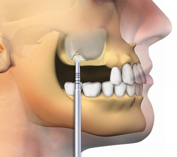 GEN-OS - OSTEO BIOL - TECNOSS - immagine 3