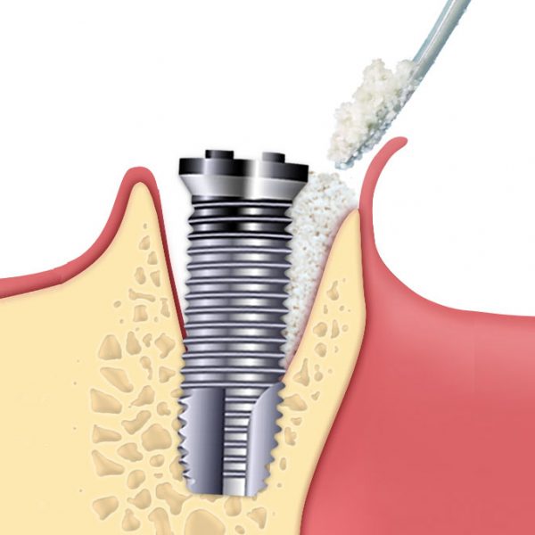 GEN-OS - OSTEO BIOL - TECNOSS - immagine 8
