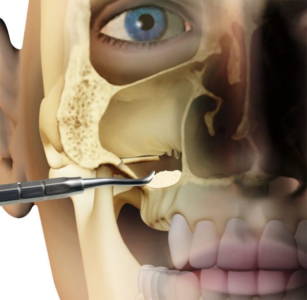 GEN-OS - OSTEO BIOL - TECNOSS - immagine 11